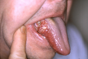 dolor en la lengua