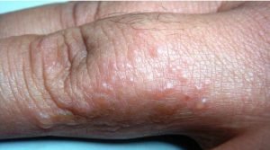eczema-dishidrotico