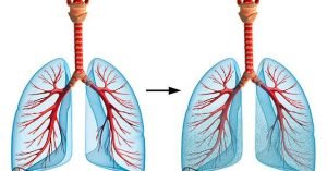edema-pulmonar