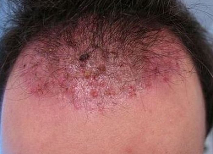 itchy-bumps-on-scalp