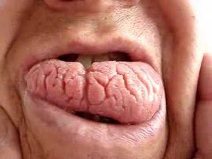 lengua-escrotal