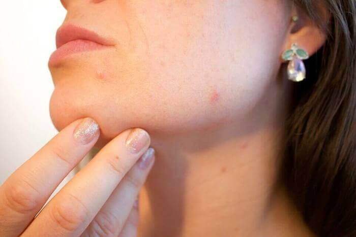 ¿Qué tan común es el acné?