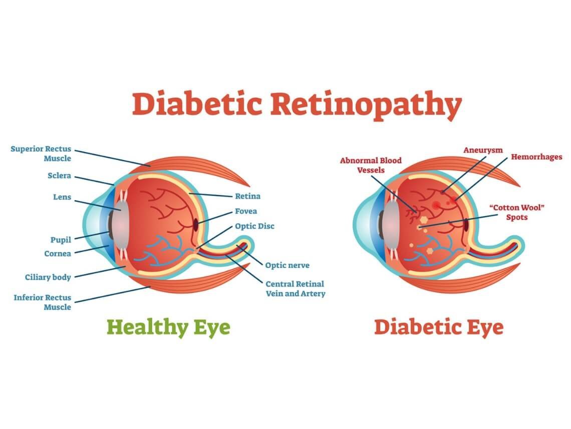 retinopatia-diabetica-causas-sintomas-prevencion-y-cura