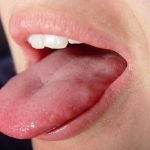 dolor en la lengua