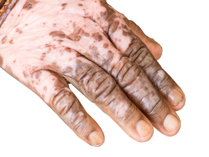 curar vitiligo sabila