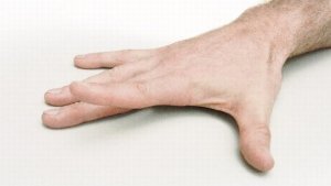 arthritis in the hands