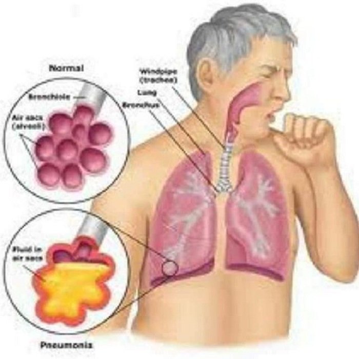 bronconeumonia