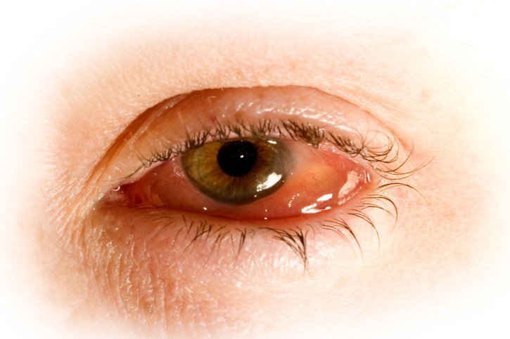 inflamacion ocular interna