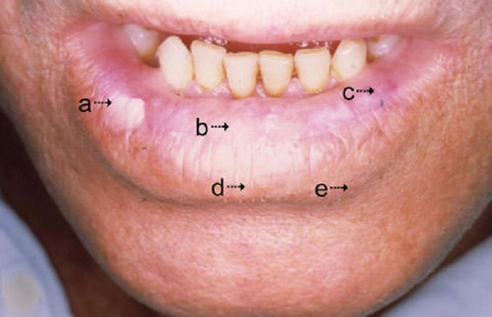 queilitis actinica