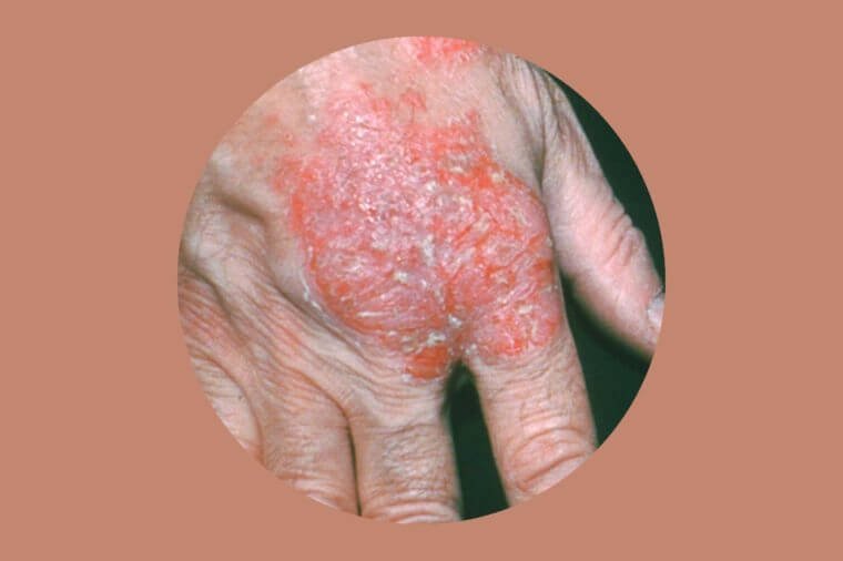 nummular-eczema