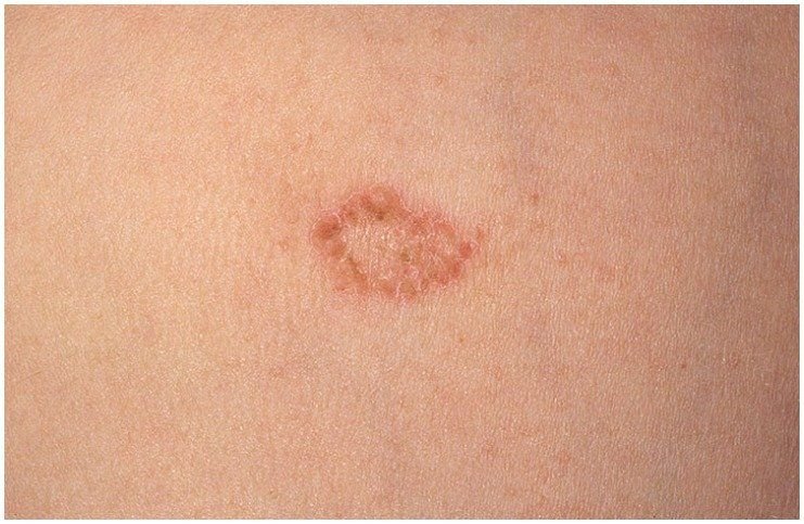 tratamiento natural del eczema nummular
