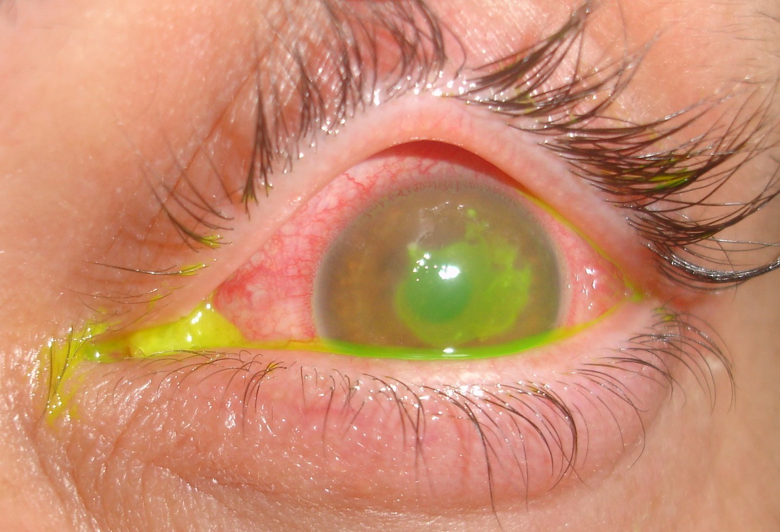 ulcera-corneal