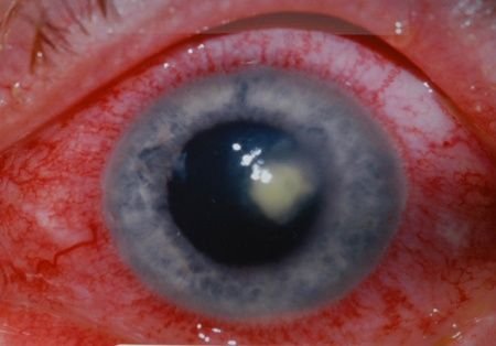 ulcera de cornea