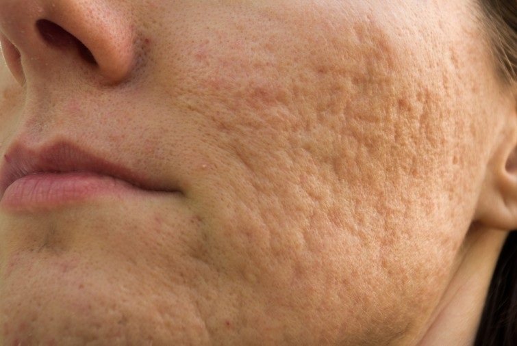 manuka-miel-por-acne