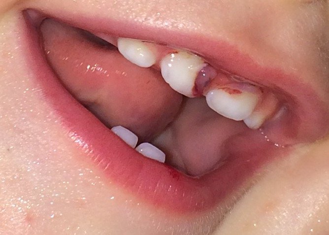 sabiduria-dientes-eliminacion
