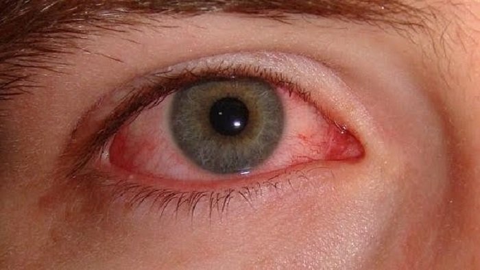 ojos amarillos enfermedad