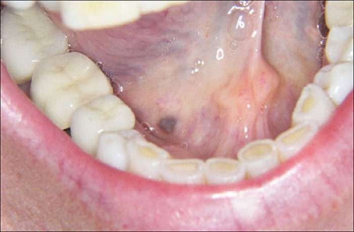 mácula melanótica oral