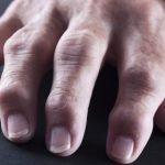 Artritis reumatoidea causas síntomas y tratamiento