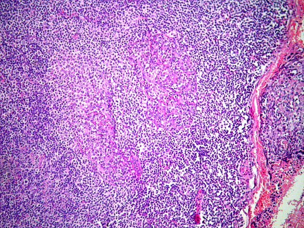 Carcinoma de células escamosas de epiglotis