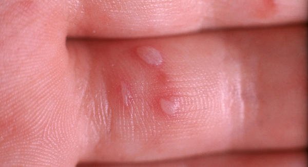 Coxsackie Virus Rash síntomas causas y tratamiento