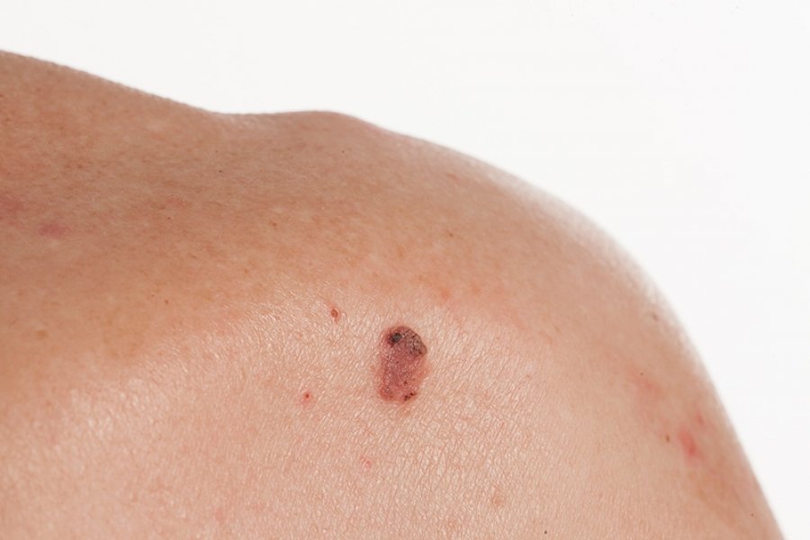 Cuál es el tipo más peligroso de cáncer de piel