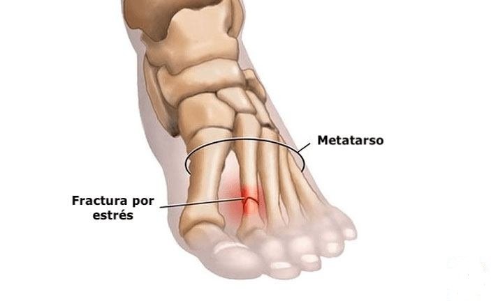 Cómo se siente una fractura por estrés en el pie