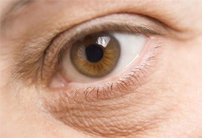 Eczema alrededor de los ojos causas y formas de tratamiento