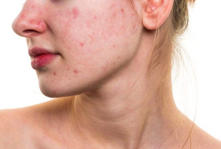 Enrojecimiento de la cara y la piel causas tratamiento y prevención