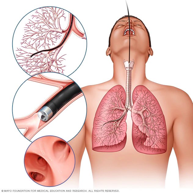Lista de síntomas del cáncer de pulmón y preguntas frecuentes