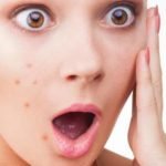 Los mejores antibióticos tópicos para el acné que puede comprar sin receta