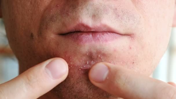Qué causa la mucosidad negra en la nariz o las motas negras en la mucosa