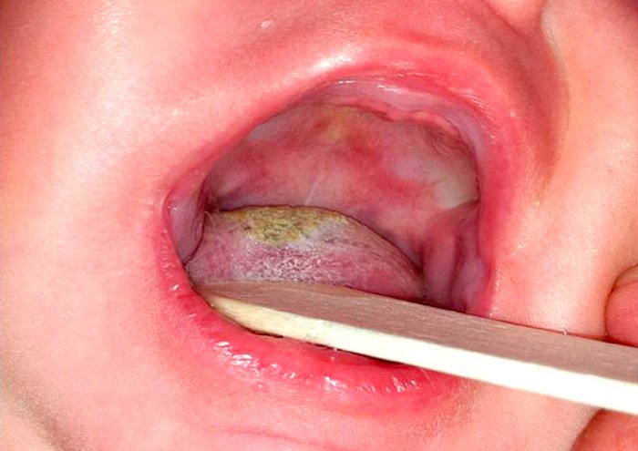 Sangre en la saliva causas síntomas tratamiento