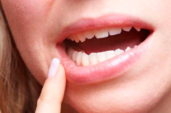 Techo de la boca hinchado: causas y tratamiento