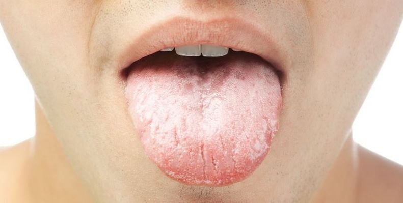 cancer de boca sintomas iniciales