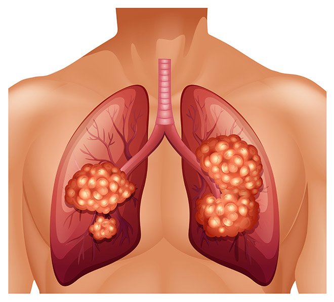 cancer de pulmon con pronostico