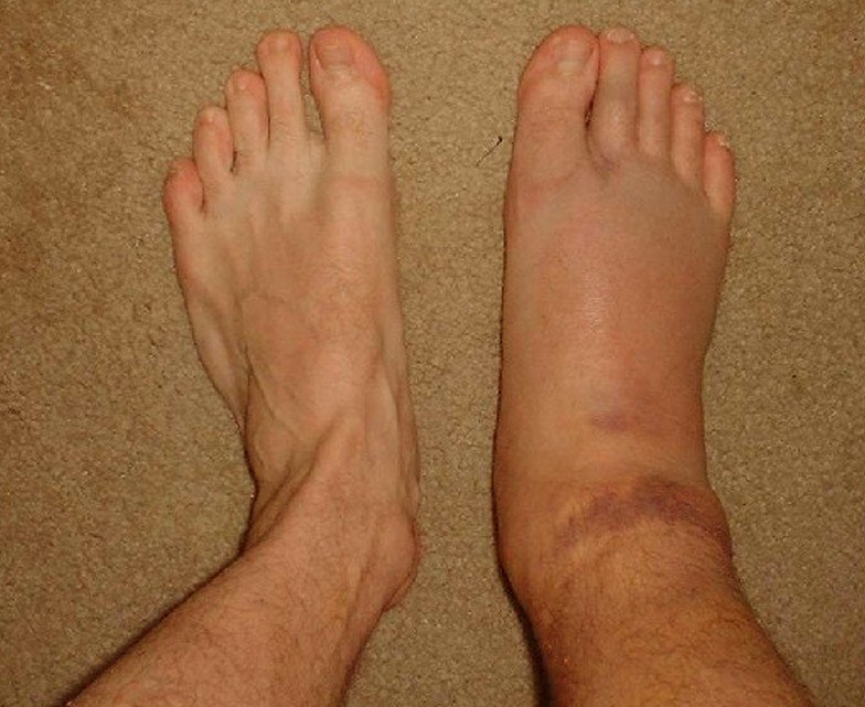 Sprained Ankle Pictures 