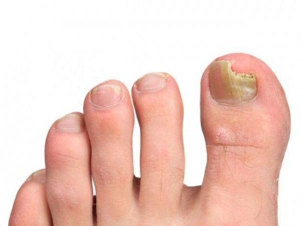 Los hongos del dedo del pie son contagiosos