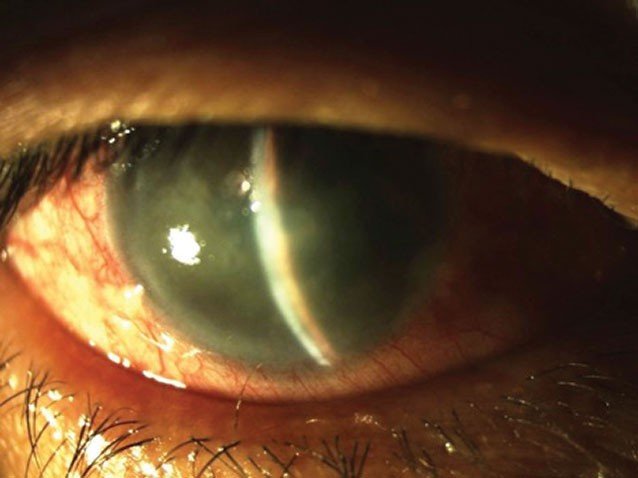 ataque de glaucoma agudo
