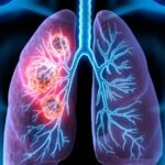 cancer de pulmon