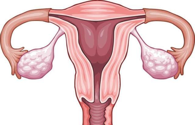 endometrio engrosado