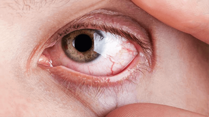 explosion vasos sanguineos ojo peligroso