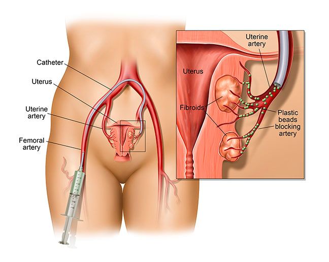 fibroides tumor utero