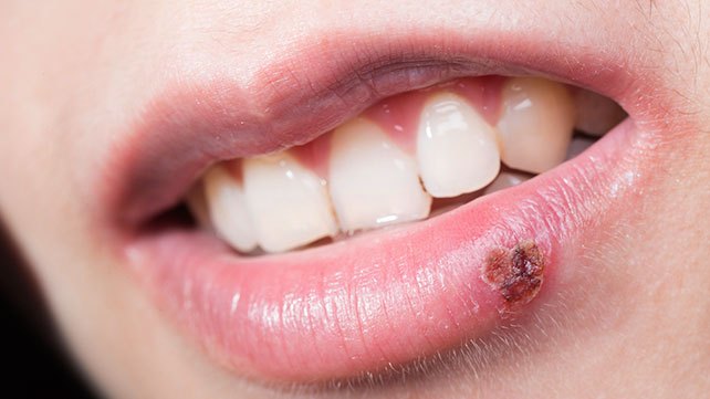 herpes labial oral herpes