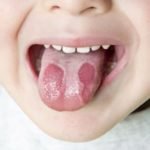 lengua color definicion lengua infeccion
