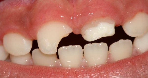 procedimiento de reparacion de dientes astillados