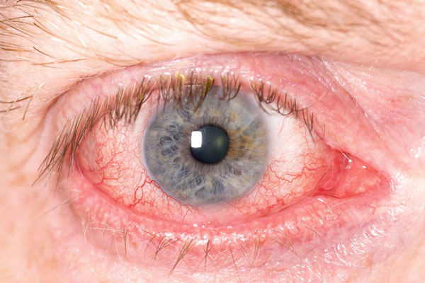 sarcoidosis ojos problemas