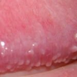 Herpes genital en la cabeza del pene