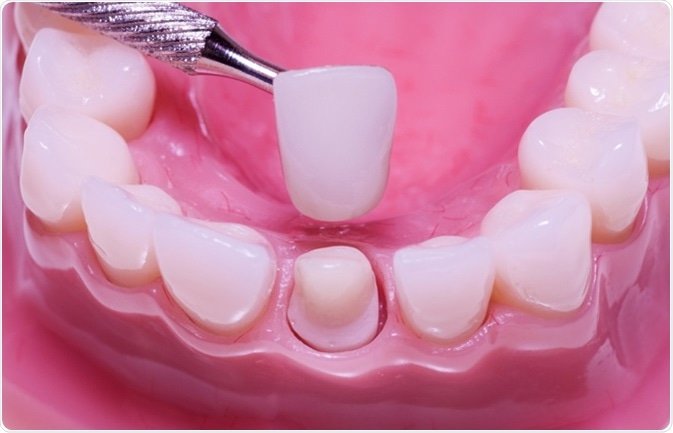 procedimiento de llenado de dientes