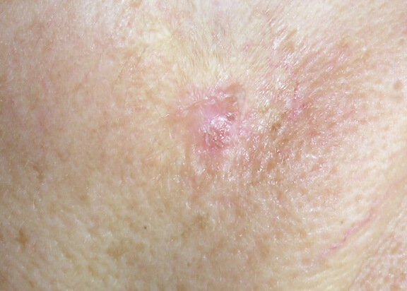 el cancer de piel pica y quema