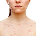cuales-son-los-diferentes-tipos-de-acne